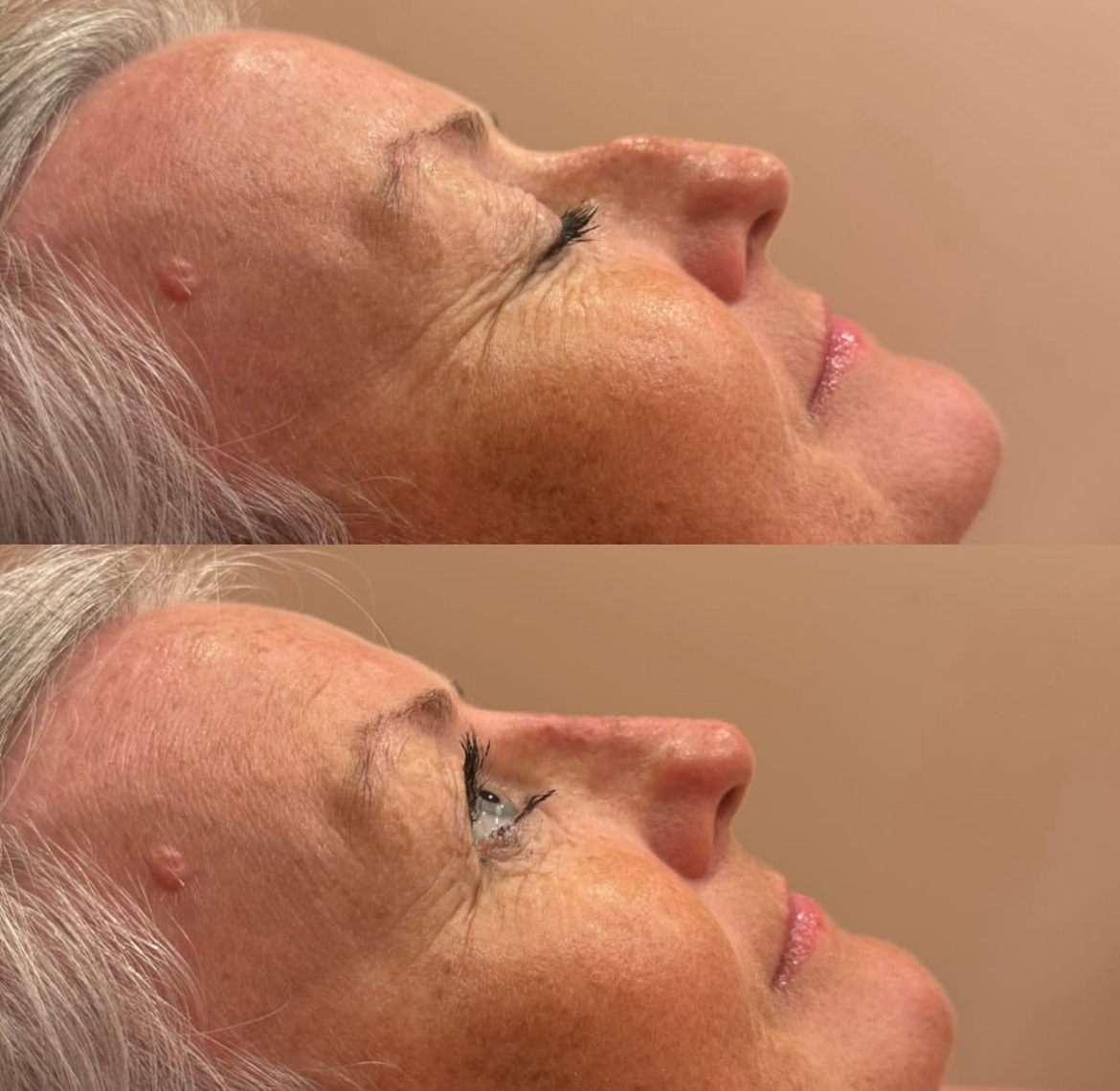 Dorsal hump removal result